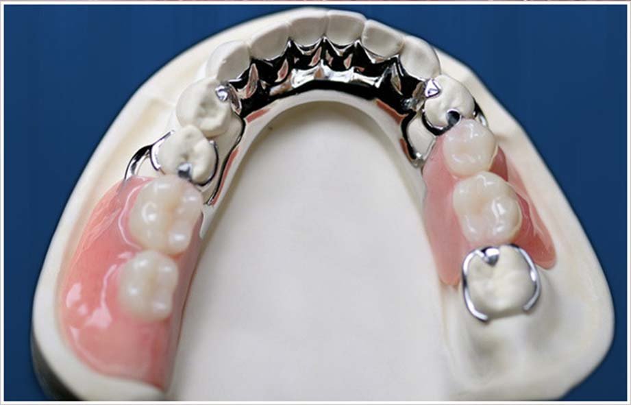 Cast Partial Dentures